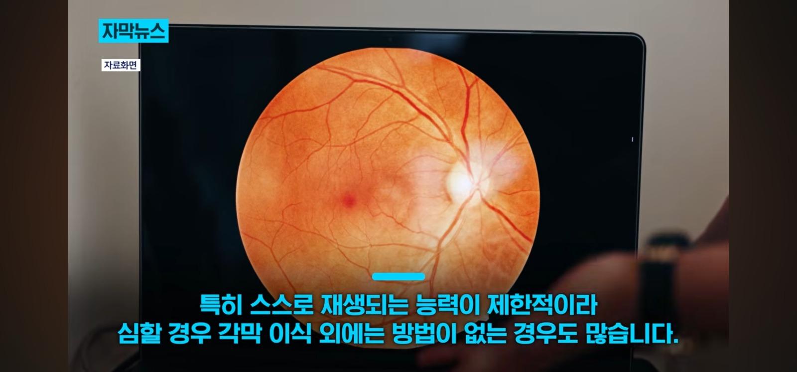 살아있는 인공각막 만드는데 성공