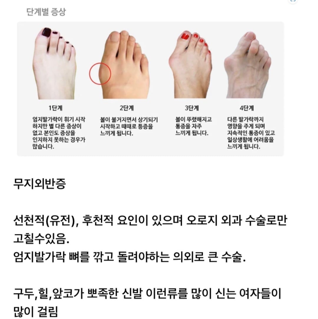 여자들이 걸리기 쉬운 발 질환