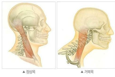 '거북목' 되지 말기 tip