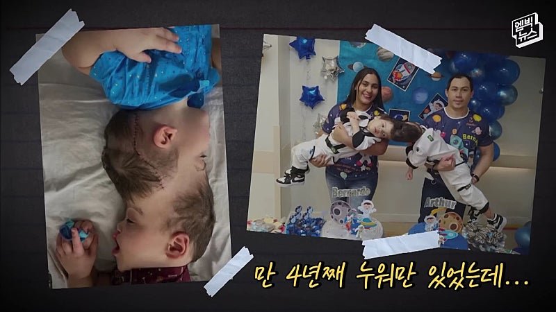 33시간 수술 끝에 얼굴 본 쌍둥이