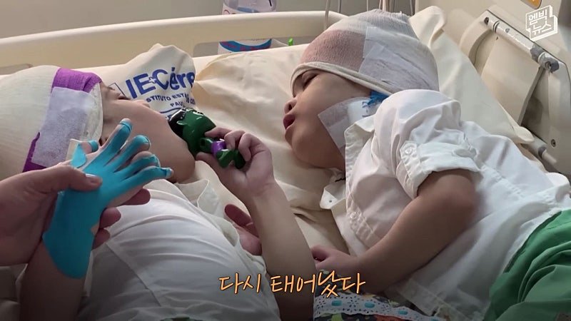 33시간 수술 끝에 얼굴 본 쌍둥이