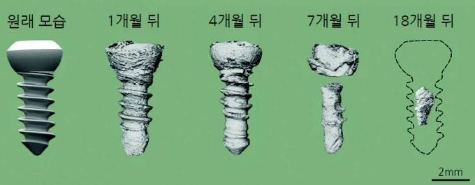 요즘 뼈에 박는 나사 근황.medical