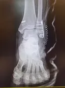 인방, 혐주의) 풍월량 발목부상이 얼마정도인지 짐작해보기