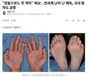 "콘돔으로도 못 막아" 비상...전세계 난리 난 매독, 국내 환자도 급증