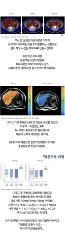 마운자로 1년 맞았더니 내장지방에 생긴 변화