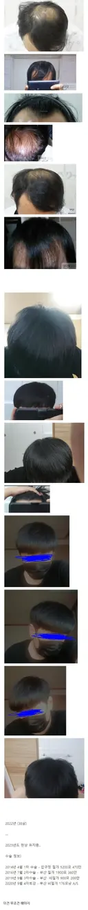 모발이식에 천만원 투자한 38살 결과물..jpg
